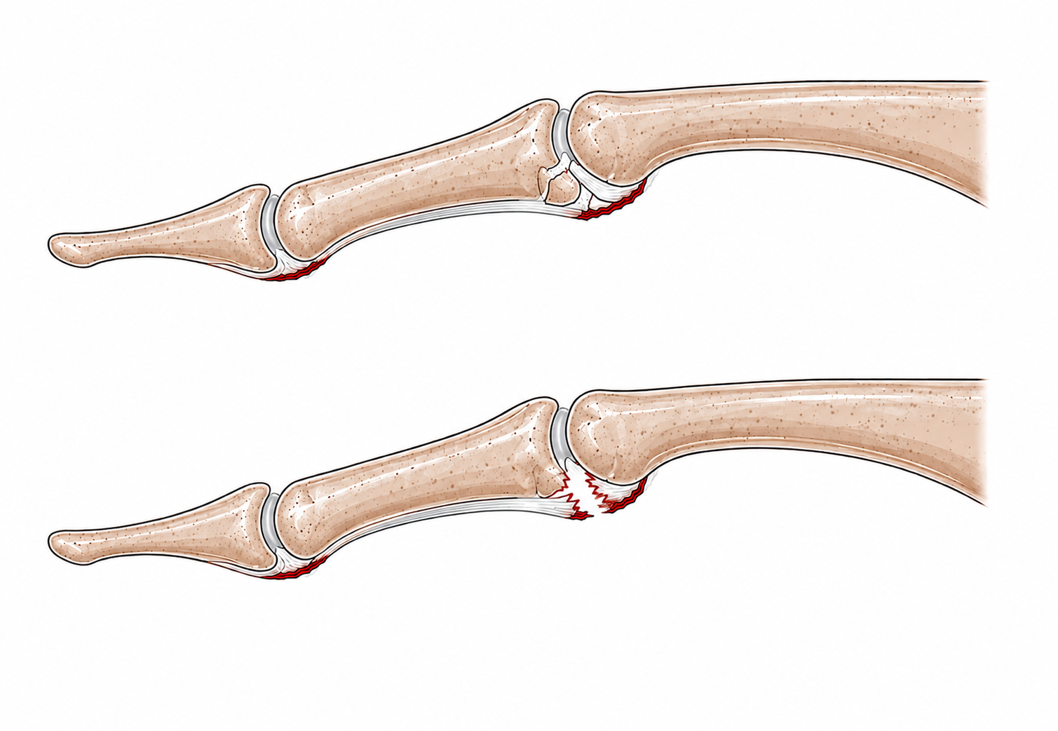 Entorsa de deget — ilustrație anatomică