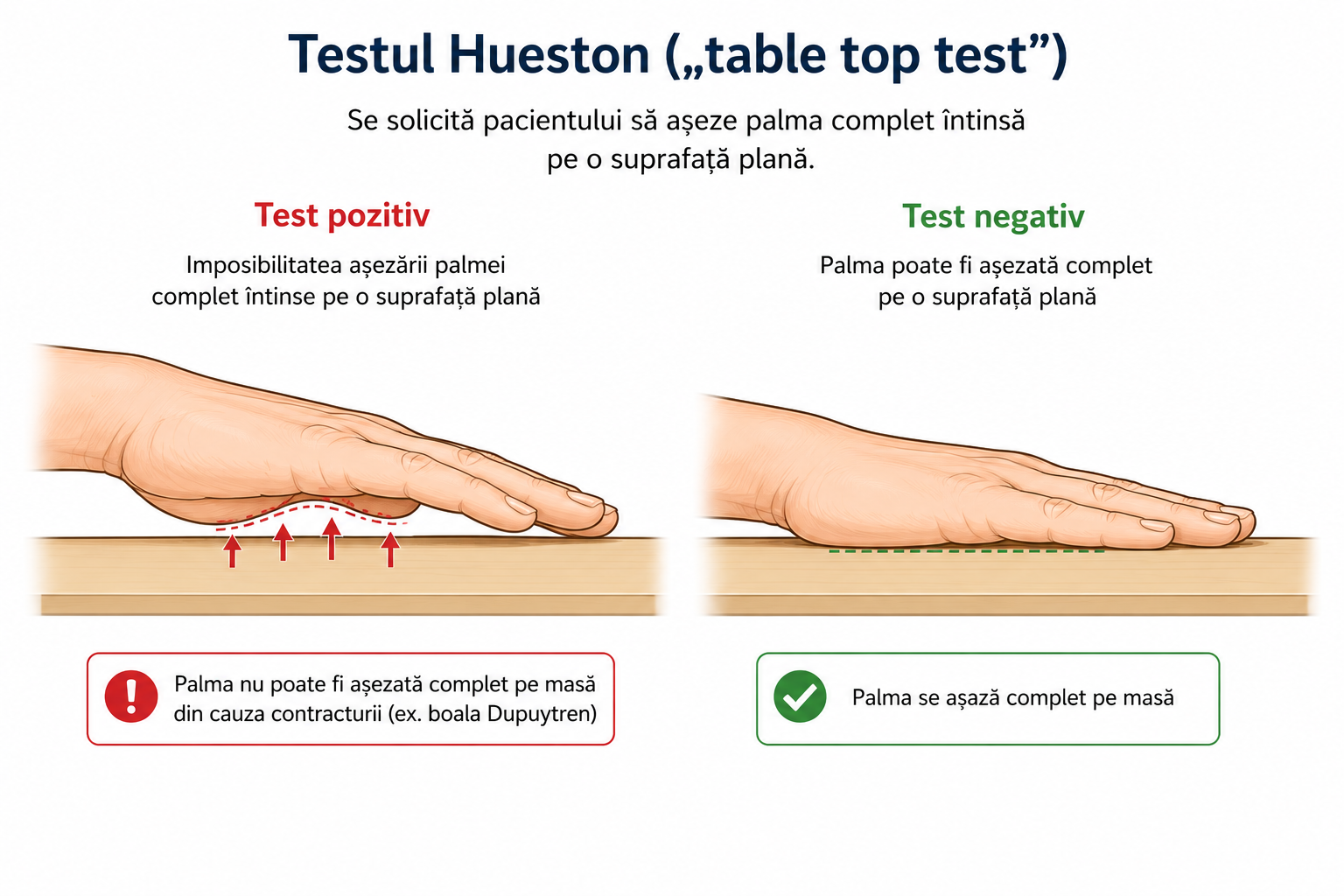 Maladia Dupuytren — test clinic